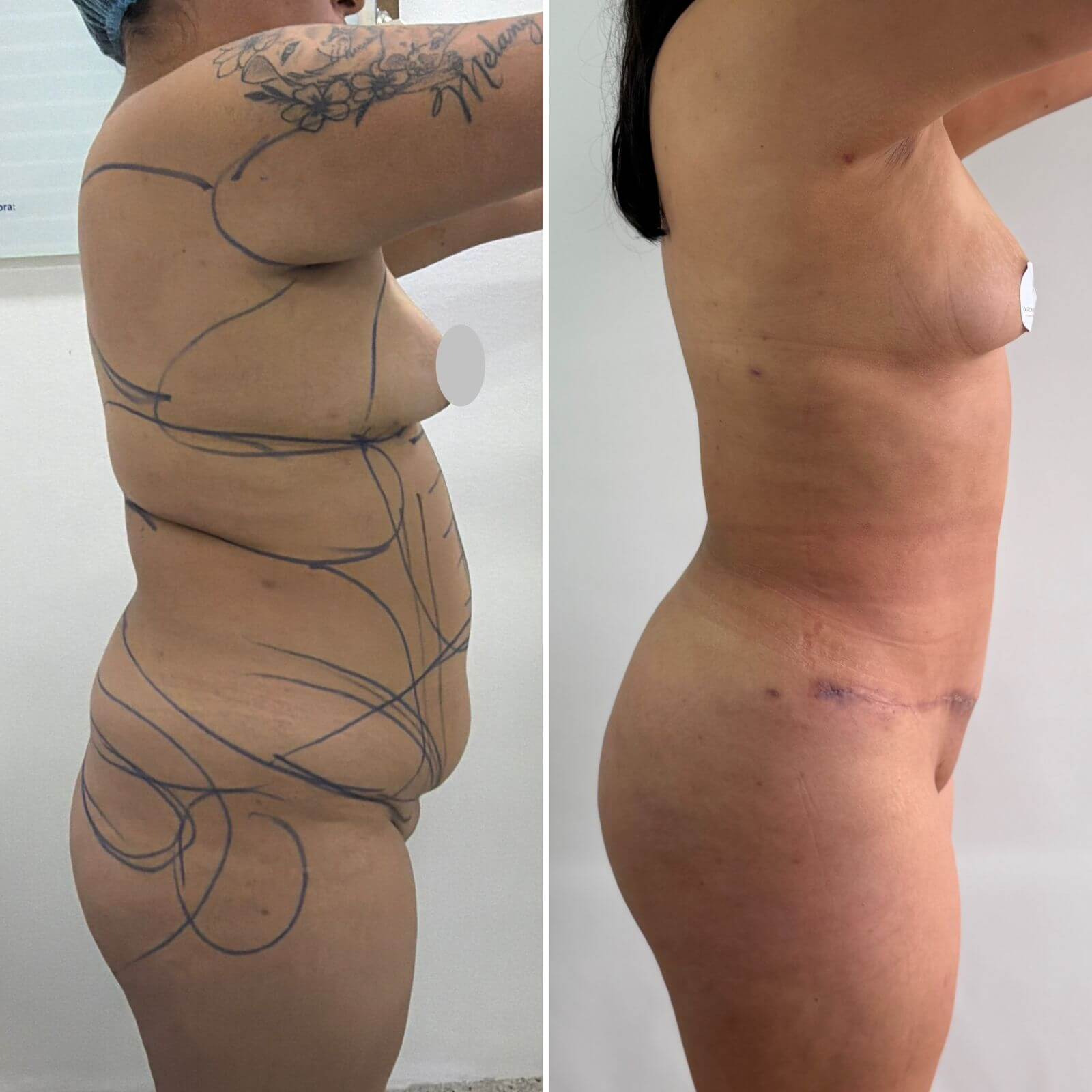 Caso femenino perfil antes y después clínico