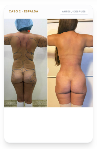Caso femenino espalda antes y después clínico